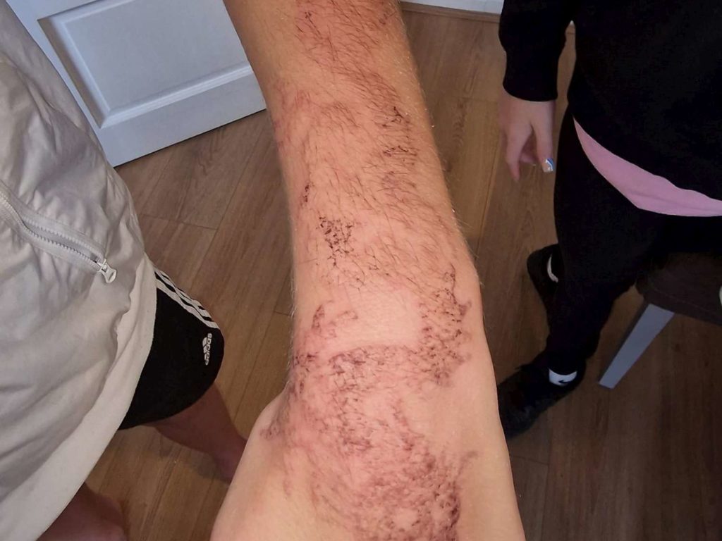 Kind lässt sich im Urlaub Henna-Tattoo tätowieren: Verbrennungen am Arm