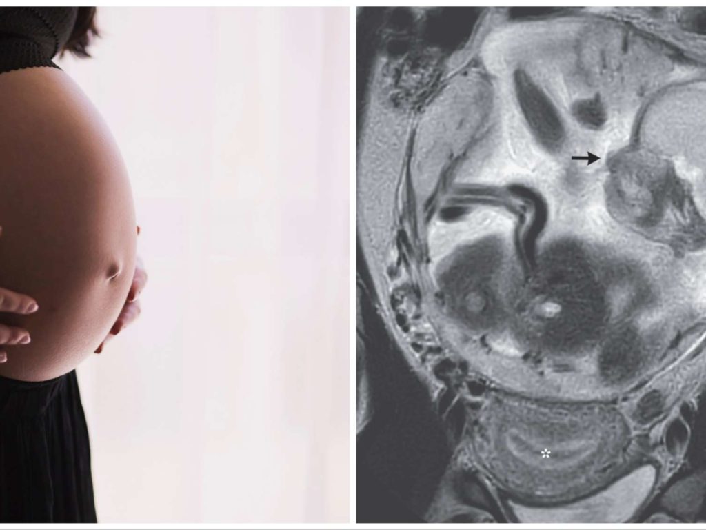 En el hospital por dolor de estómago, estaba embarazada: pero el feto crecía en el intestino