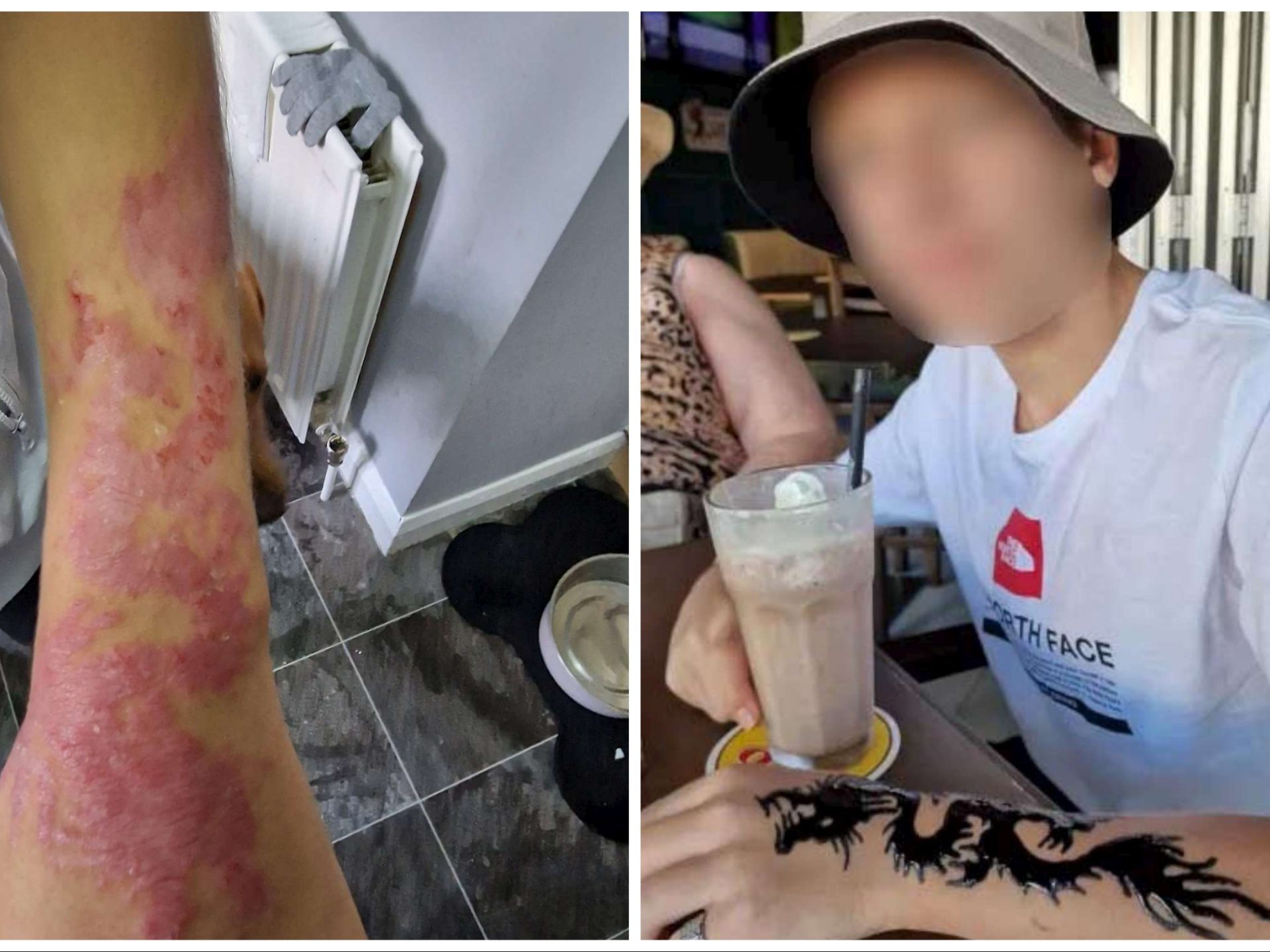 Niño se tatúa henna durante vacaciones: se quema el brazo