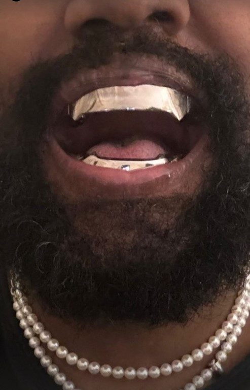 L'ultima follia di Kanye West, usa una dentiera da 850mila euro