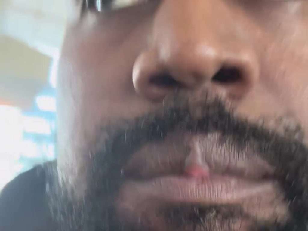 Escrescenze misteriose sul labbro di Kanye West: colpa dei nuovi denti?