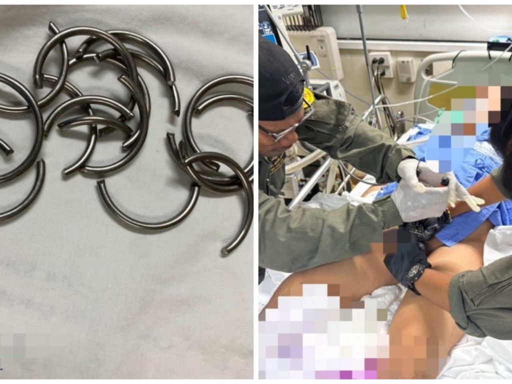 Ihm bleiben 11 Penisringe stecken und er geht ins Krankenhaus: Der Arzt rettet ihn mit einem Drahtschneider